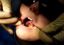 There were around 140 hospital admissions in Bury to remove children's decaying teeth last year